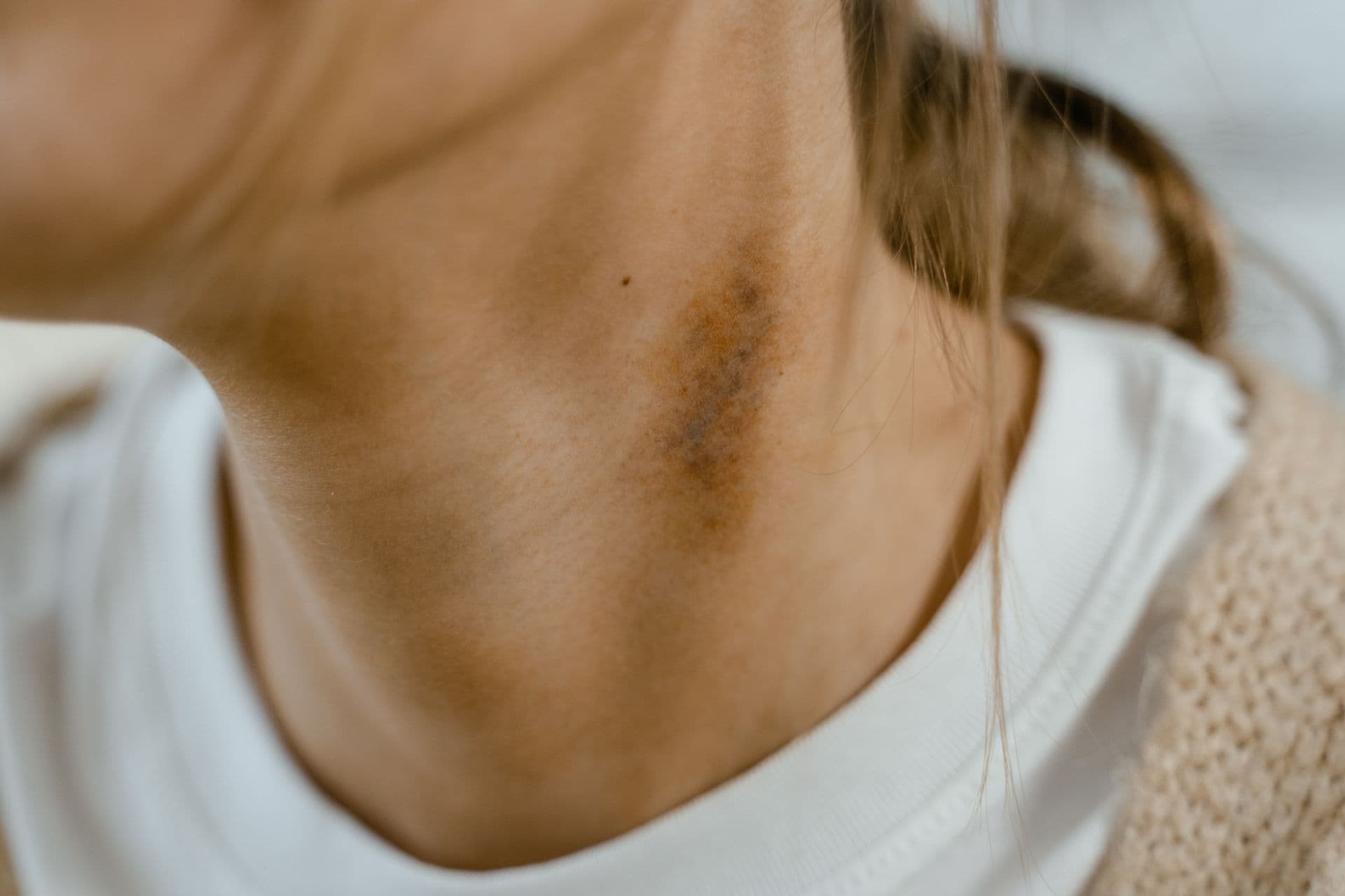 Zmiana koloru znamienia – kiedy nie zwlekać z konsultacją dermatologiczną